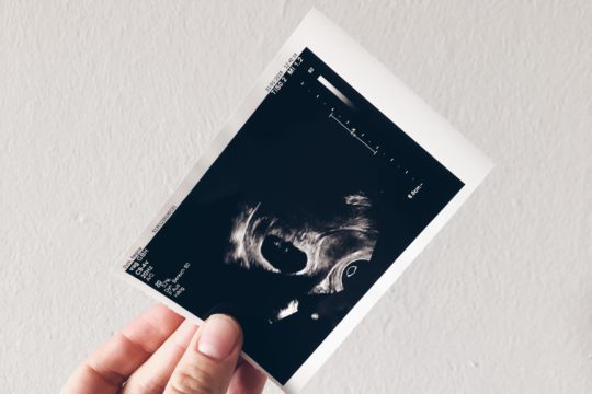 Fehlgeburt | MIssed Abortion in SSW 11 | Daily Malina